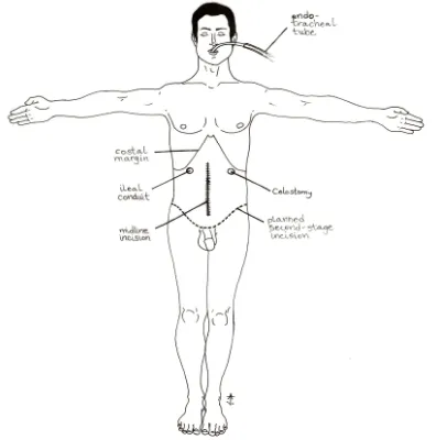 Fig. 1. The patient after stage 1 of a two-stage 