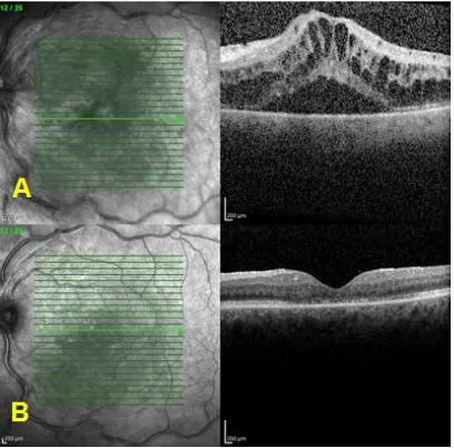 Fig. 2. OCT scans. Before (A) and after the injections (B) 