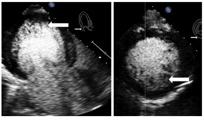 Fig. 2. Apical three and two chamber view  demonstrating noncompaction of the left rating noncompaction of the left ventricle