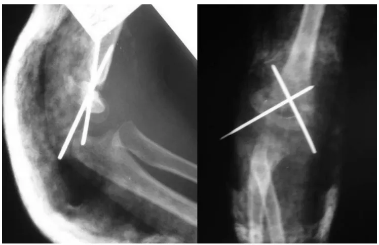 Fig. 8a. Pre-op radiograph of posteriorly displaced supracondylar fracture with fair  clinical result 