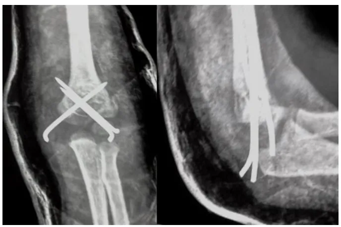 Fig. 6a. Pre-op radiograph of postero-laterally displaced supracondylar fracture 