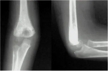 Fig. 6d. Clinical photograph of post-op case of postero-laterlly displaced supracondylar  fracture after fracture union showing elbow movements 