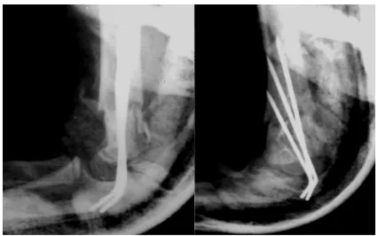 Fig. 7a. Pre-op radiograph of isolated posteriorly displaced supracondylar fracture 