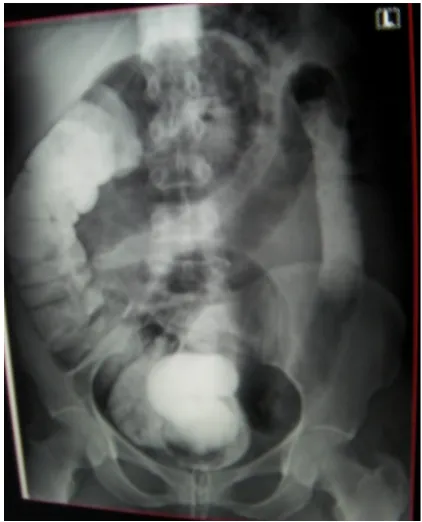 Fig. 3. Showing the left half of the colon without haustral markings, severely narrowed