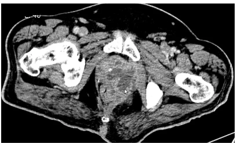 Fig. 1. CT image of prostatic abscess