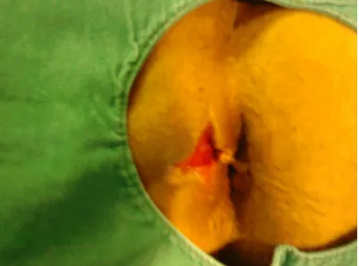 Fig. 3.  Image of perianal abscess after surgical management