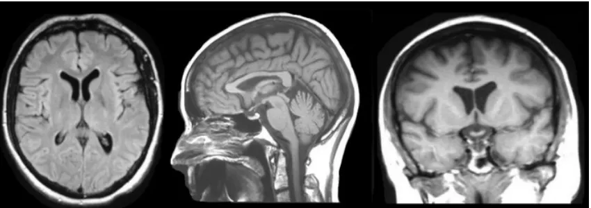 Figure 1.4: Sample MRI scans of a brain in the three different axes - Axial, Coronal andSagittal in order