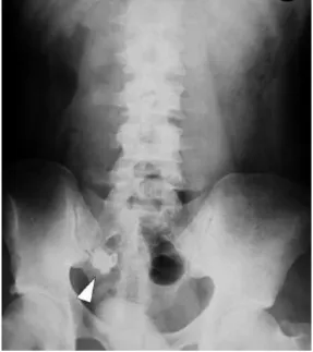 Figure 4 : Plain X-ray abdomen showing appendiculolith 