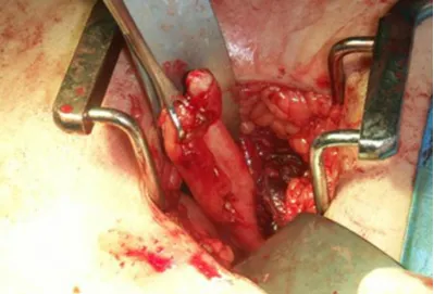 Figure 7 : Open appendicectomy foe a case of acute appendicitis 