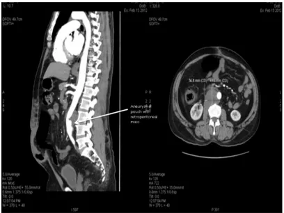 Fig. 1. CT revealing aneurysm at infra renal segment of aorta below the level of renal