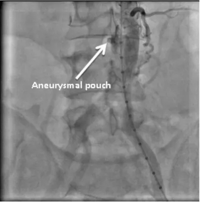 Fig. 2. Aortogram showing aneurismal pouch - 5cm below the renal artery leveltowards the right side of the aorta without any aneurismal leak