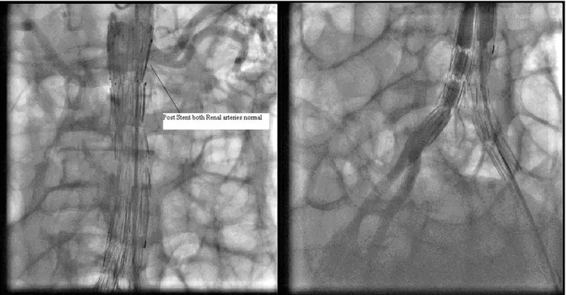 Fig. 3. Aortogram showing successful deployment of the bifurcation stent withoutcompromising renal blood flow