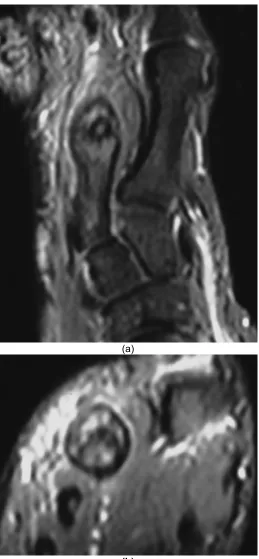 Fig. 3. MRI images showed an osteogenic lesion with a central nidus associated withboth intraosseous (a) and surrounding soft tissue (b) edema