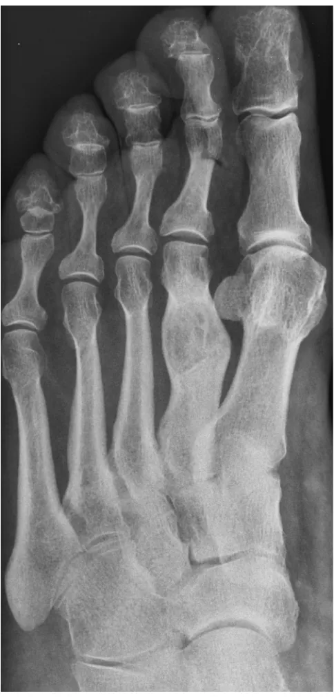 Fig. 6. Significant remodeling of the shaft of the second metatarsal was evident7 years post-operatively