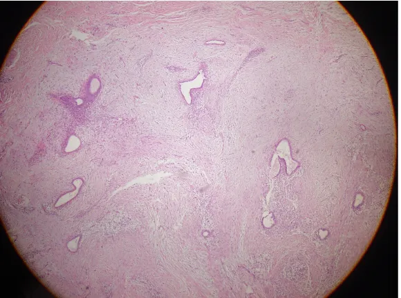 Fig. 2. Histopathological illustration of surgical scar endometriosis: endometrialstroma surrounding endometrial glands in fibrous tissue (HE, X40)