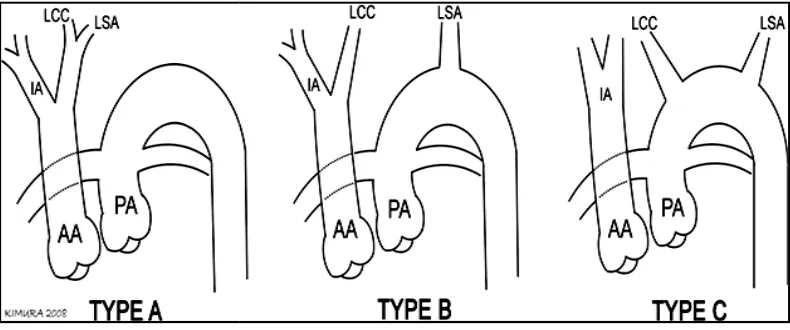 Fig. 8. Celoria and Patton classification of IAA [28]. Type A is defined as an = ascending aorta (LSA)between the left common carotid arterydescending thoracic aorta reconstitutes from the pulmonary artery