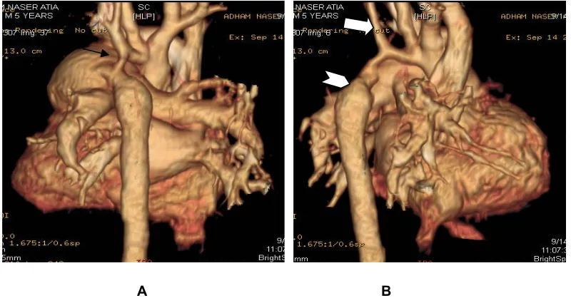 Fig. 9A and B: 3D reconstructed images showing the ascending aorta continues as