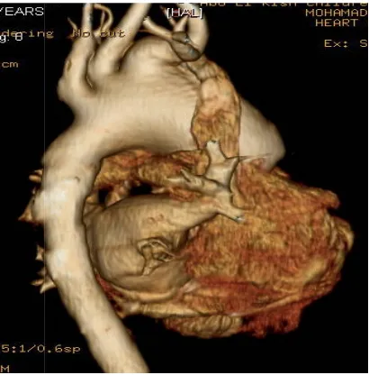 Fig. 11. Mori classification of aortopulmonary window [31]. Type I or proximalFig. 11