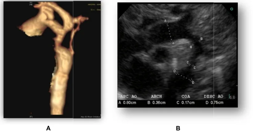 Fig. 2. 3D reconstruction image showing (A) hypoplastic aortic arch with multipleFig. 2