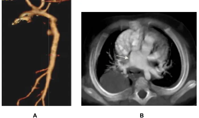 Fig. 4A. 3D reconstruction image of the globally hypoplastic aorta with relativelyFig