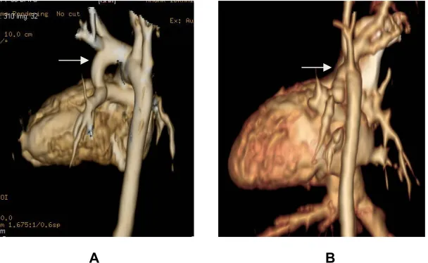 Fig. 7A. 3D reconstructed image of a patient with atretic pulmonary trunk, narrowedboth pulmonary branches, right sided aortic arch, aberrant left SCA and a largecurved PDA (arrow) that joins the origin of LPA with narrower end and gives ariseto left CCA a