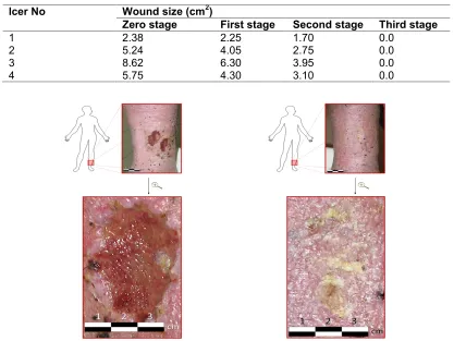 Table 1. The changes in wound size during FlaxAid therapy. The measurements weretaken during the last visit of each stage of the study
