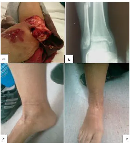 Fig. 2. Photographs preoperatively (a) and postoperatively (b) with the two Steinman stabilization of the limb 