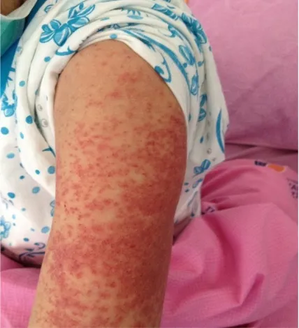 Fig. 1. Localized maculopapular eruptions on the front of the left arm