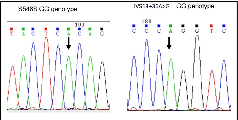 Table 2 clearly indicates that an individual does not carry variant allele of both thepolymorphisms, instead each individual is found to carry wild type allele of one SNP andvariant allele of the other leading to compound heterozygosity/Genetic compound.