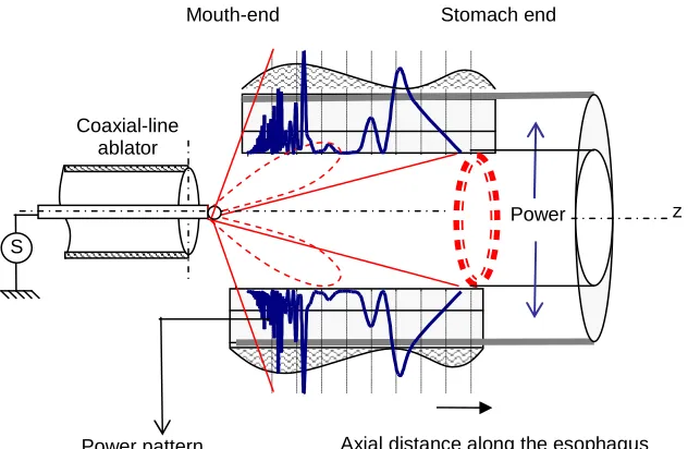Fig. 2A. Barrett’s esophagus model toward EM ablation considerations 