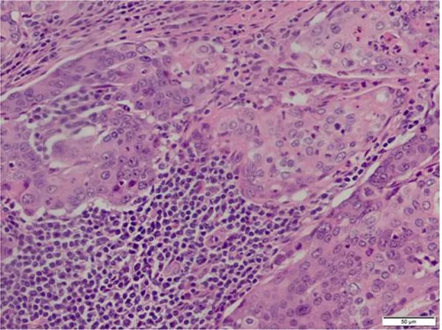 Fig. 3. Histology showing HE-stained mucinous adenocarcinoma of the colon. Mucinous 