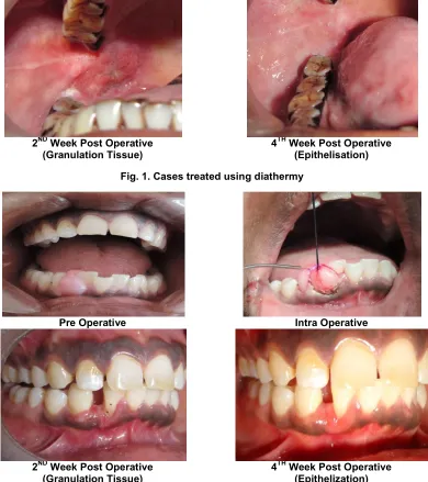 Fig. 1. Cases treated using diathermy 
