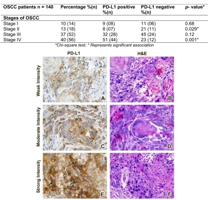 Table 4. Association of PD-L1 with different stages of Oral squamous cell carcinoma  