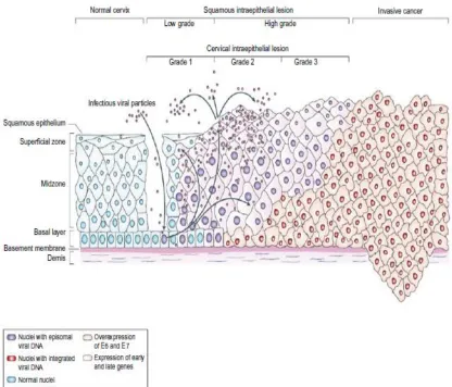 Fig 1: Pathogenesis of HPV in precancerous and cancerous cervical lesion 