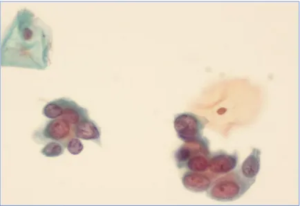 Figure 5:  High grade squamous intraepithelial lesion (HSIL) at 400x 