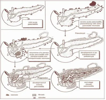 Figure No 3 - Natural history of alcohol induced pancreatitis