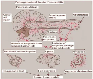 Figure No 5 - Pathogenesis of acute pancreatitis
