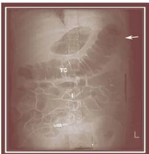 Figure No 9 - Colon cut off sign