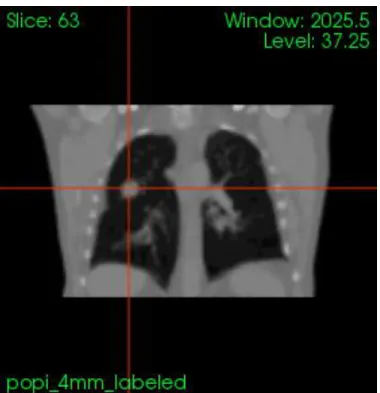 Figure 5. Sample image from the POPI patient CT. Image taken with VV 