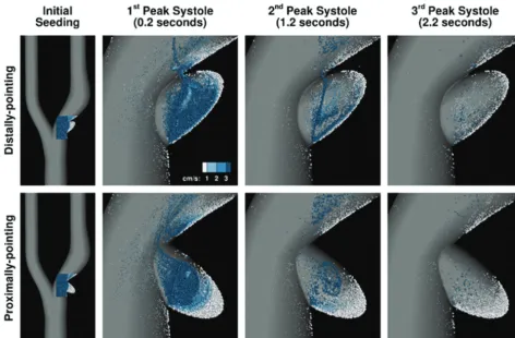 FIG 4. Visualization of ﬂow patterns computed in a 30%-stenosed carotid bifurcation with distally and proximally pointing ellipsoidal ulcers