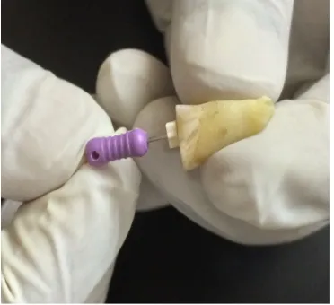 Fig 2.C: Obturation of the root canal                   