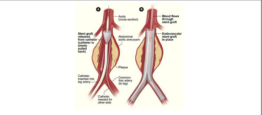 Figure 2. EVAR Procedure showing deployment of stent by catheter.  Source: https://surgery.ucsf.edu/conditions- procedures/endovascular-aneurysm-repair.aspx 