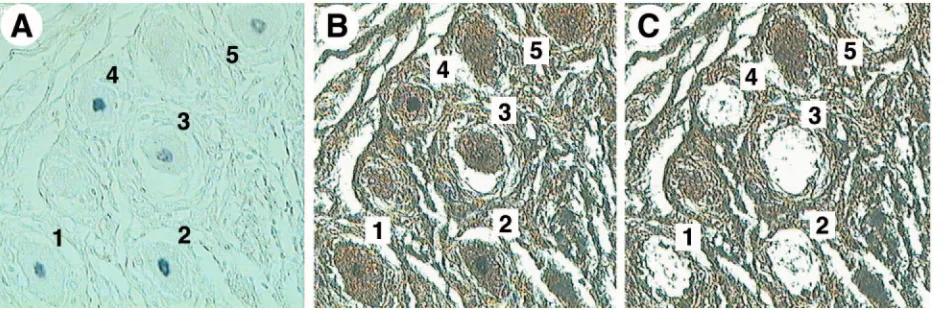 FIG. 3. HSV-1 and VZV genome copy numbers in individual PCR-positive neurons. A total of 970 single neurons captured from sections fromﬁve study subjects were tested for HSV-1 gG, of which 61 were PCR positive, with genome copy numbers/cell ranging from 5 (the lower limit of