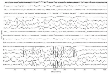 Figure 5: Raw EEG 