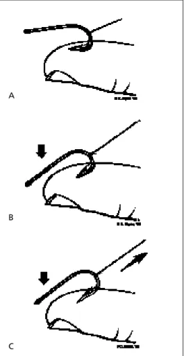 FIGURE 3. String-yank method. (A) Wrap a string around the midpoint of the bend in the fishhook