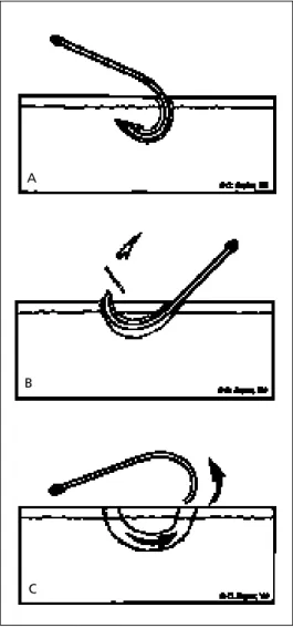 FIGURE 4. Needle cover method. (A) Advance an 18-gauge or larger-gauge needle along the fishhook until the needle opening covers the point