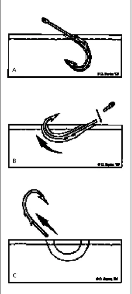 FIGURE 6. Advance and cut method: multiple- multiple-barbed fishhook. (A) The fishhook is advanced through the skin
