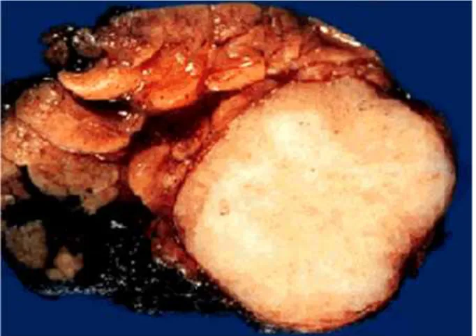 Figure 6: Macroscopic  picture of pleomorphic adenoma showing well