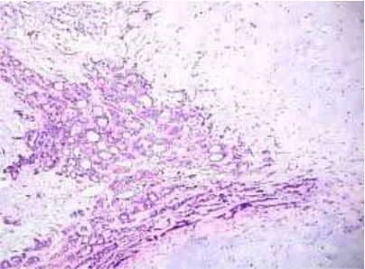 Figure7 : Benign mixed tumour showing  glandular and chondroid areas,