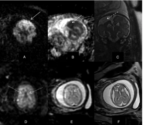 FIG 2. MR imaging ﬁndings 1 day after selective reduction showing bilateral cerebral ischemia by DWI (A, solid arrow), while T2 MR imagingﬁndings were normal (B)